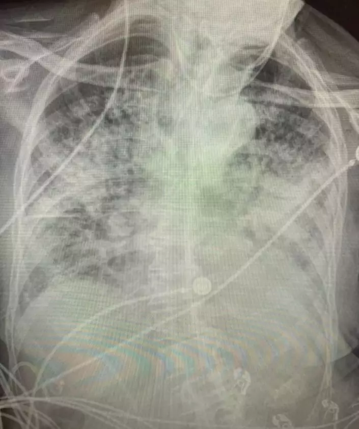 Dr Bankhead-Kendall shared a photo of a Covid patient's X-ray.