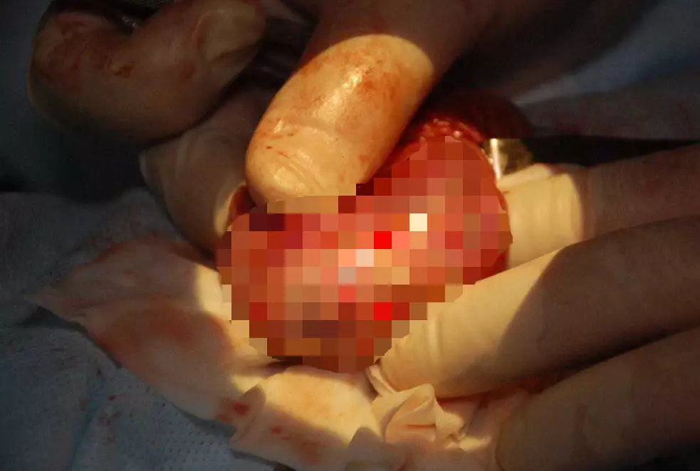 Doctors decided to operate in order to remove a lump from the teen's testicle.