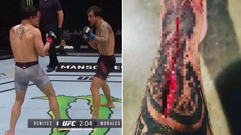 UFC Fighter Gabriel Benitez Suffers Horrifying Shin Wound