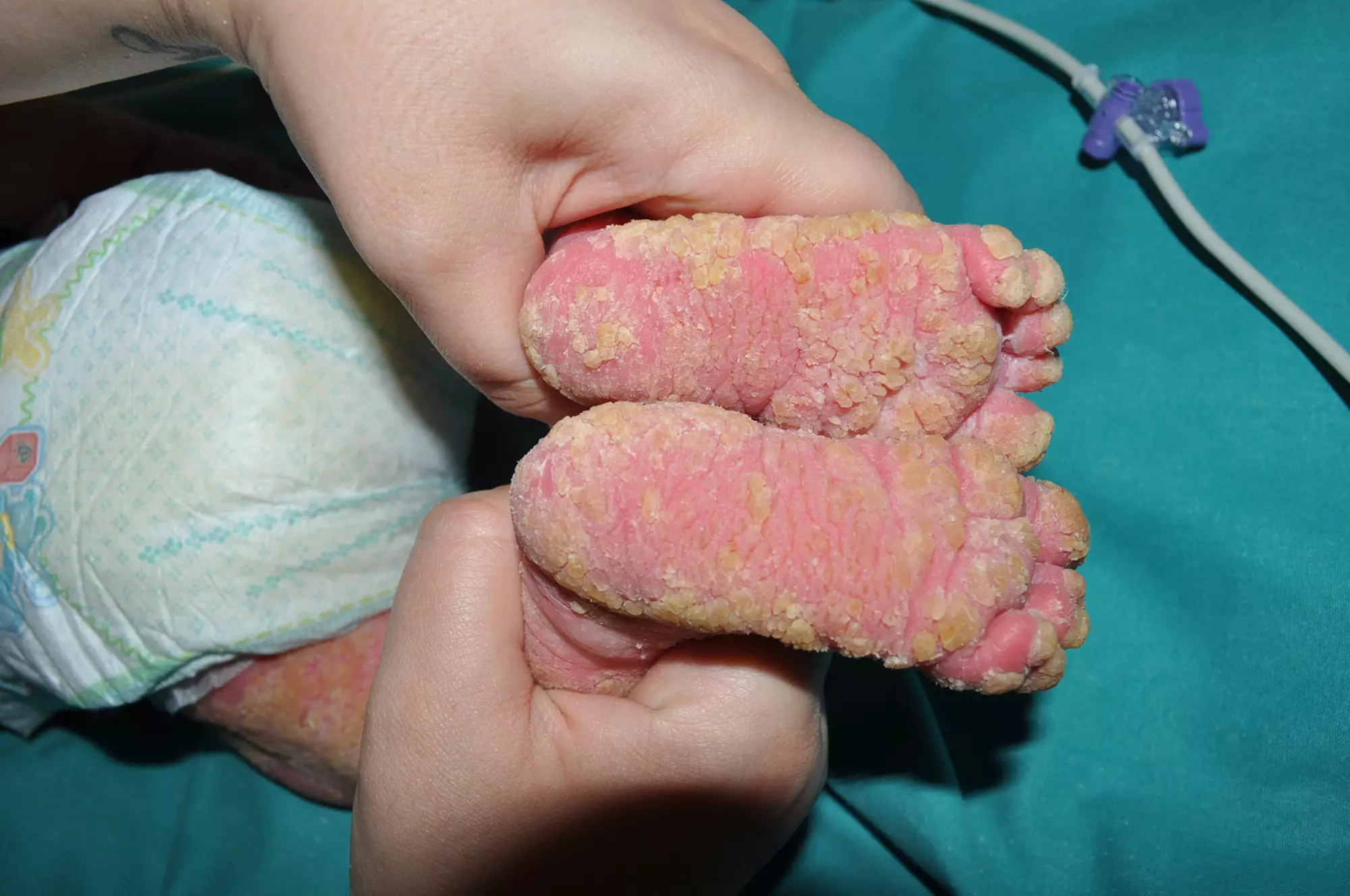 The baby's skin before treatment.