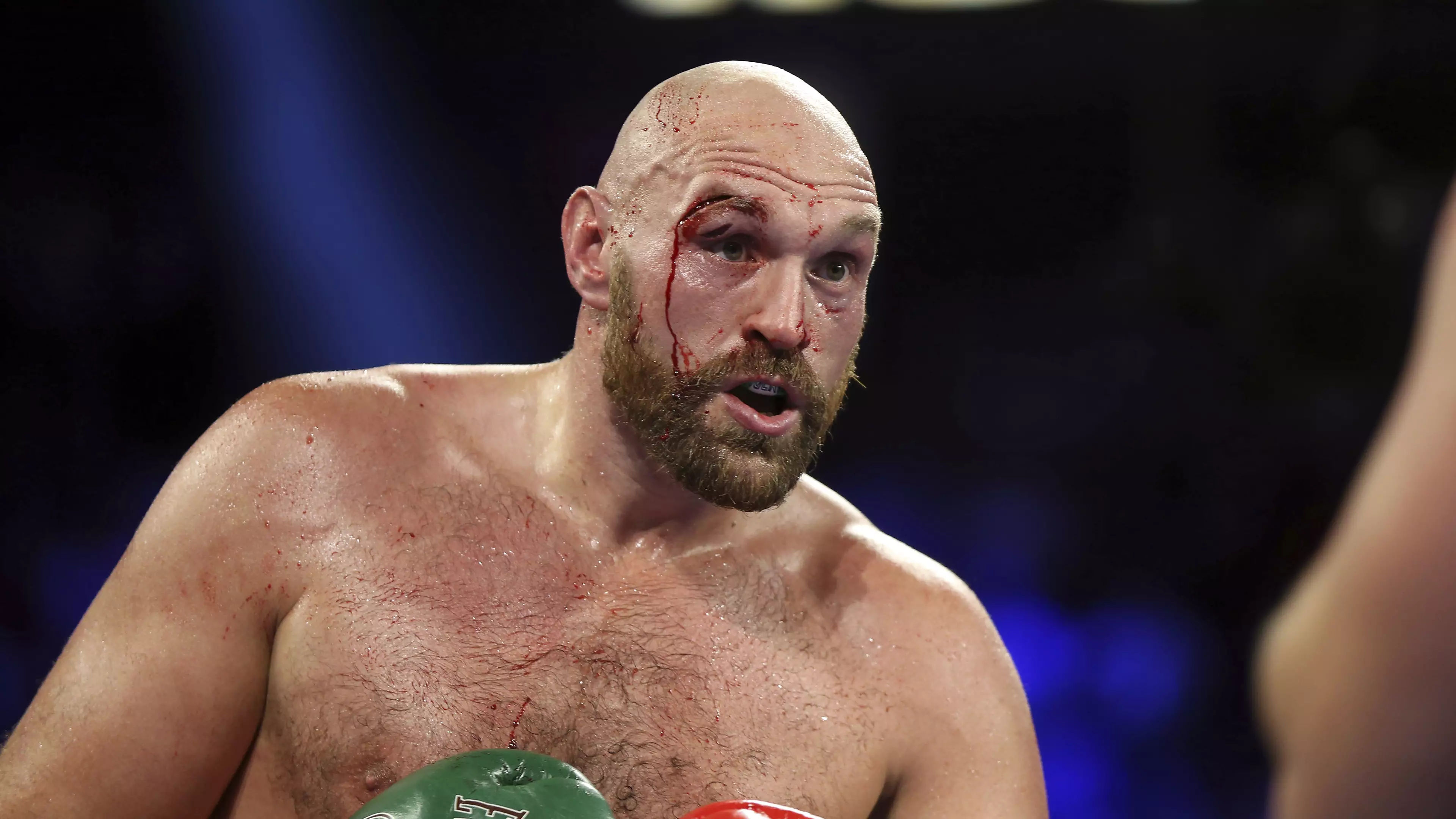 Tyson Fury Says He Had 40 Stitches And A Few Beers After Wallin Fight