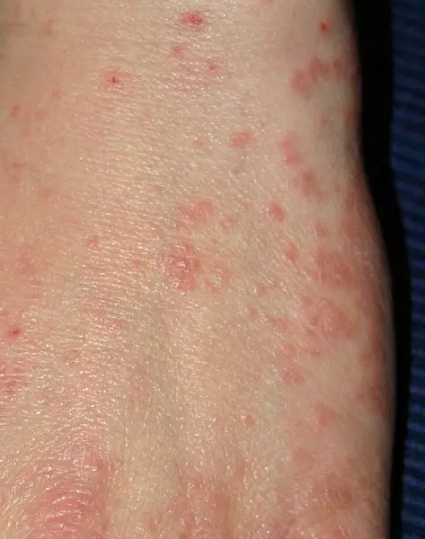 This is what scabies can look like.