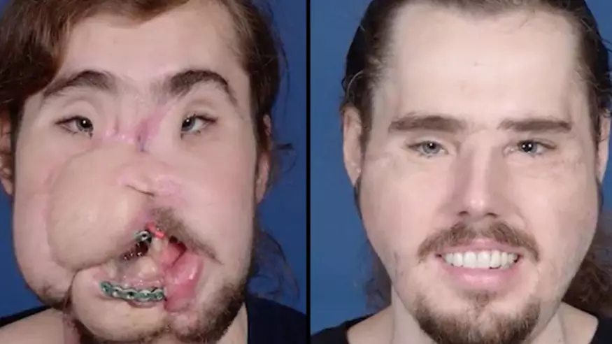 Man Who Shot Himself In The Face Undergoes Life-Changing Face Transplant 