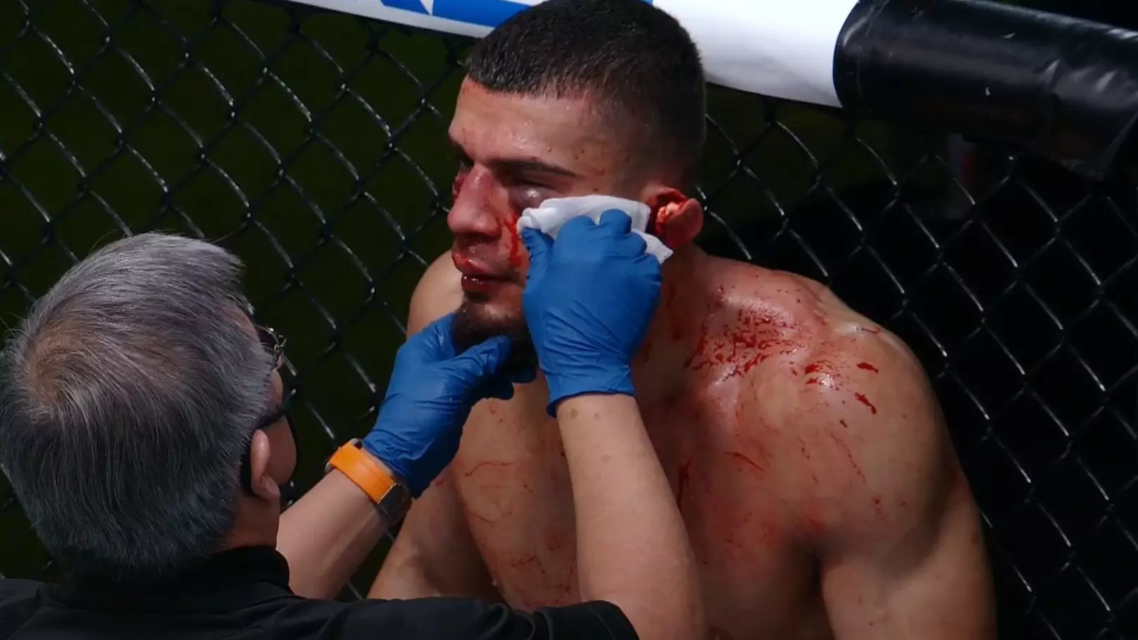 UFC Fighter Ramiz Brahimaj's Ear Left Hanging By A Thread After Brutal Elbow