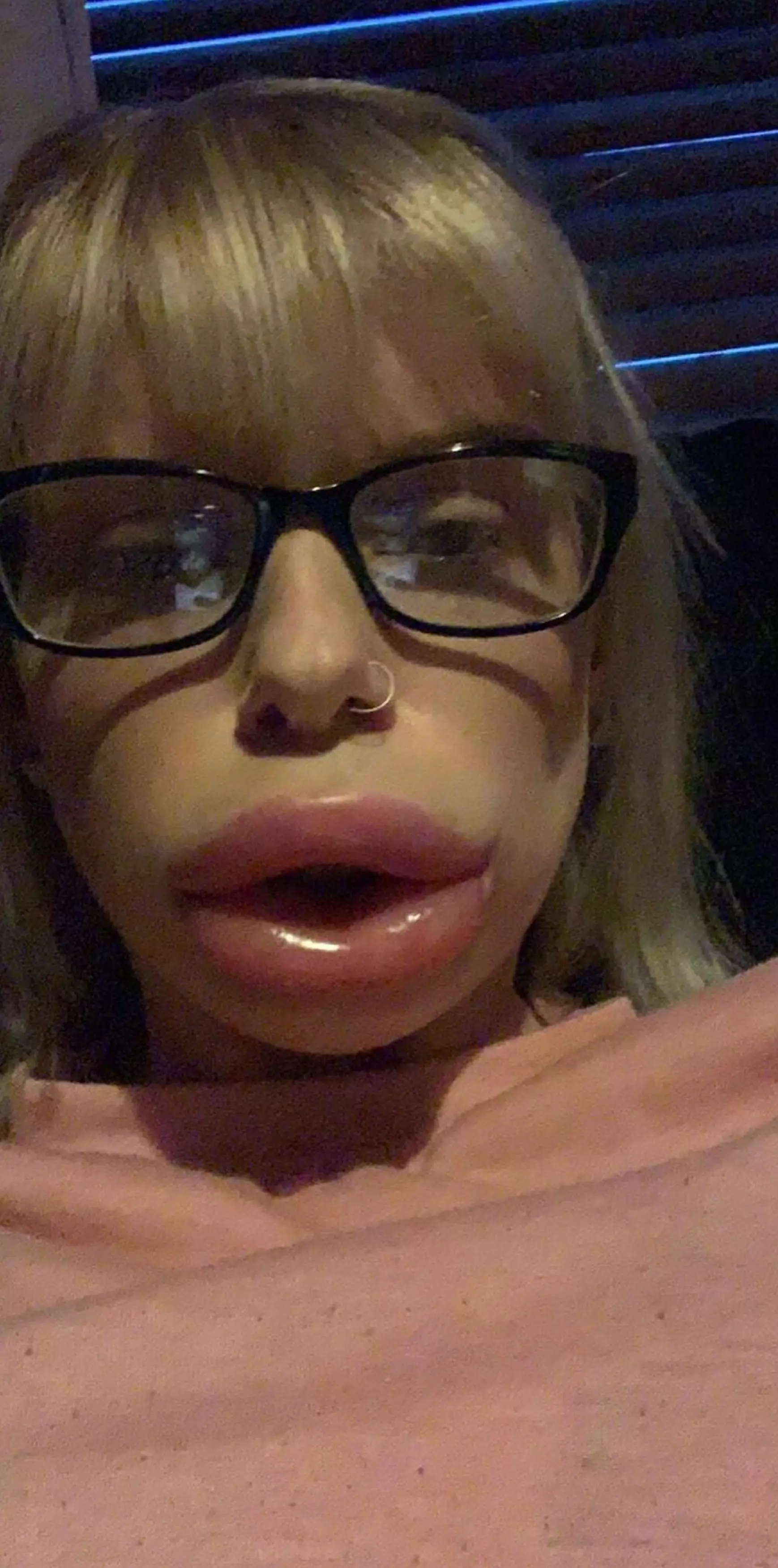 Christina's lips just hours after she had fillers.