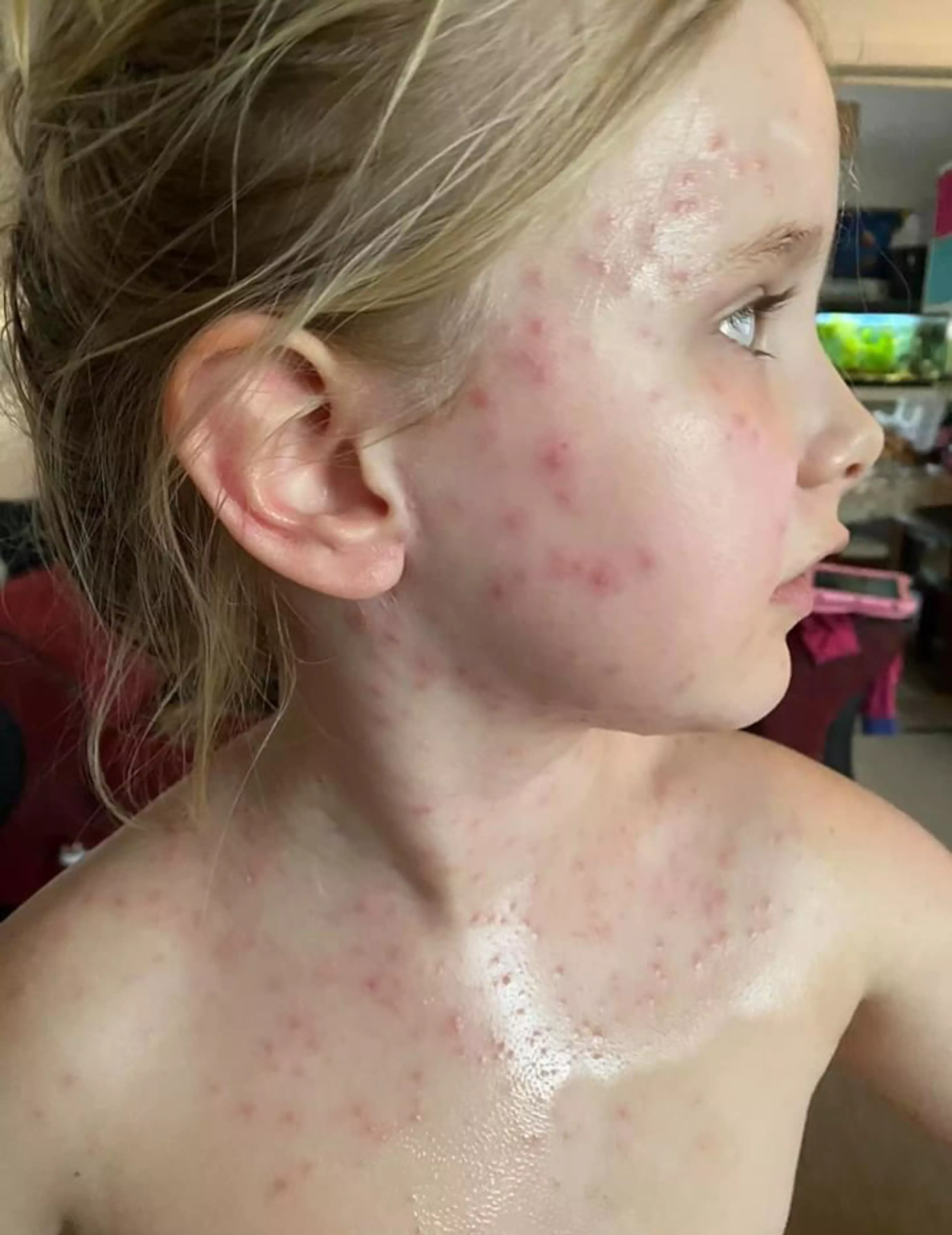 Ember, six, came up in a rash all over her upper body (