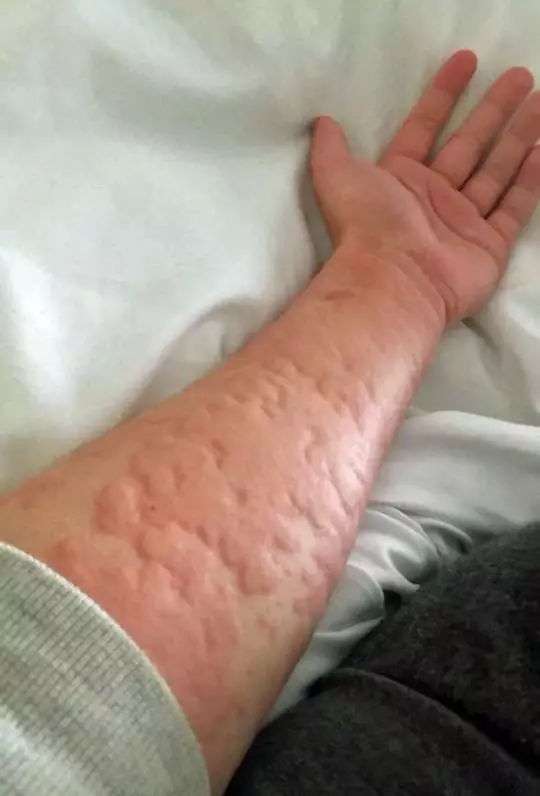 Arianna Kent shows the extent of her allergic reactions.