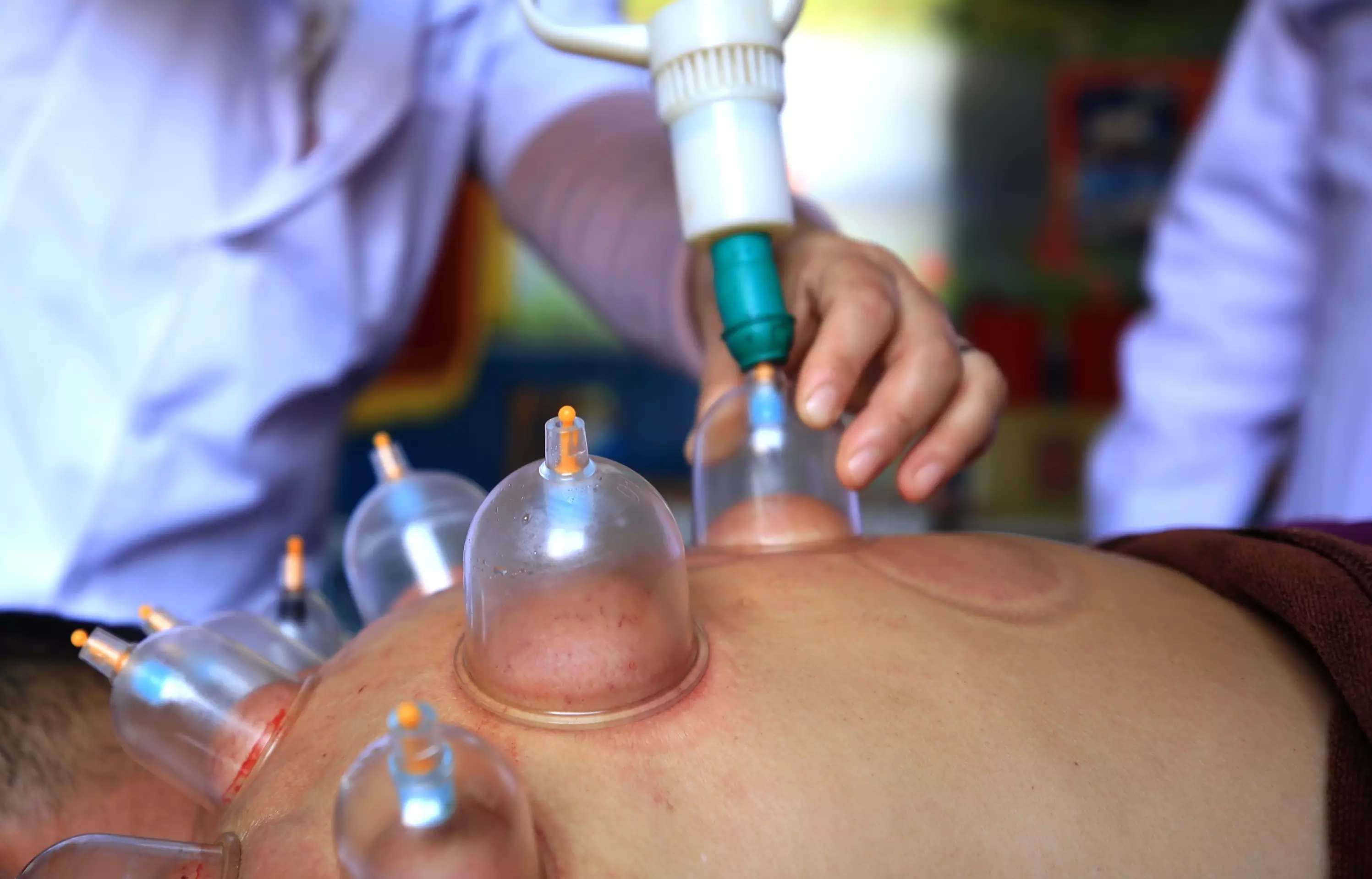 Cupping is an ancient Chinese alternative therapy used to relieve pain and improve circulation. (
