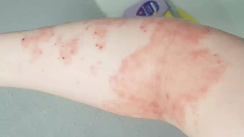 Psoriasis Sufferer Praises £22 Cream That Cleared Up Her Skin In Four Weeks