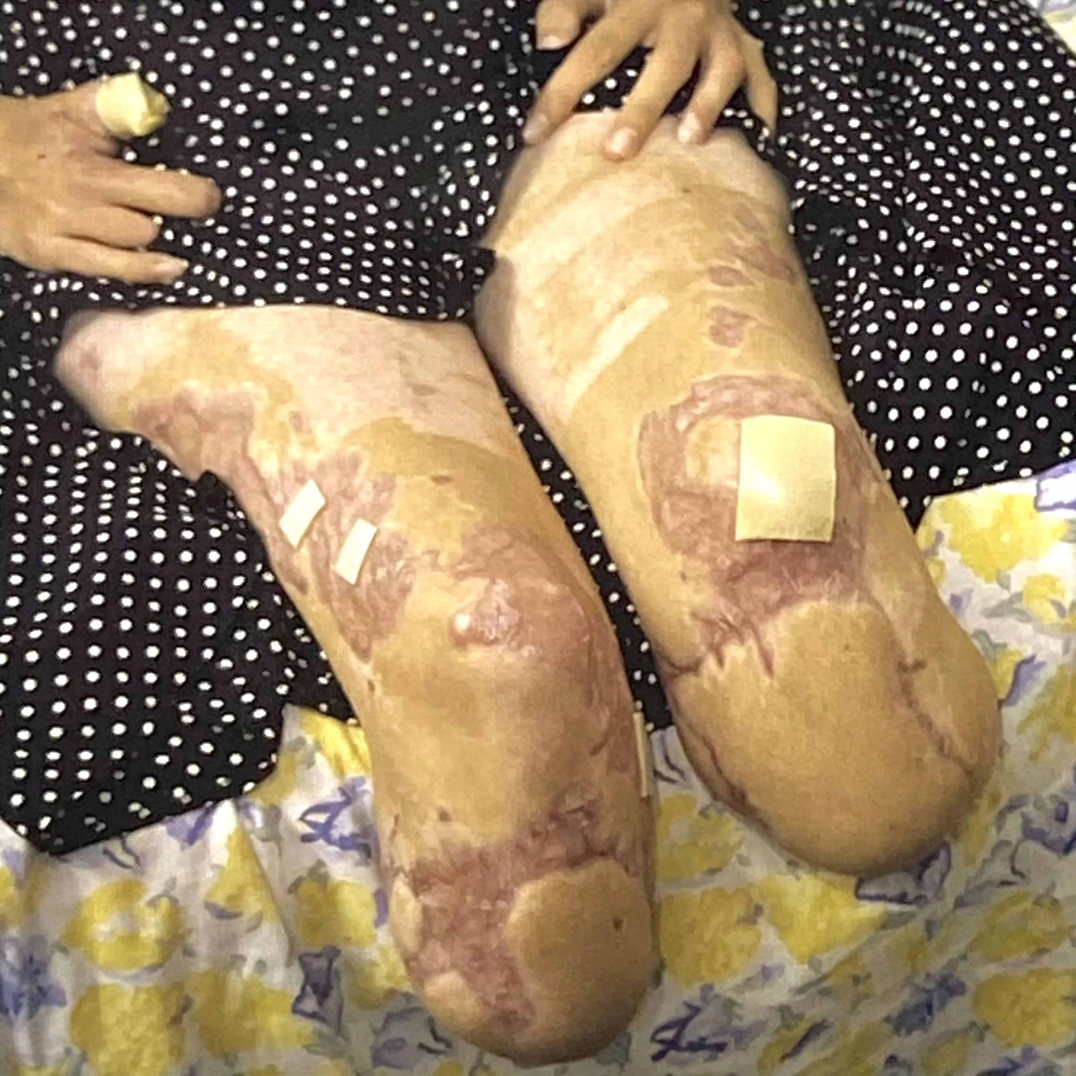 Sophia's limbs after amputation (