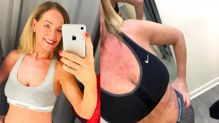Woman Reveals How She 'Cured' Horrendous Skin Condition With 'Miracle' Diet After 35 Years