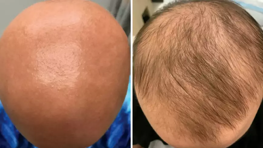 Eczema Drug Spurs 'Significant' Hair Regrowth In Teenager With Alopecia