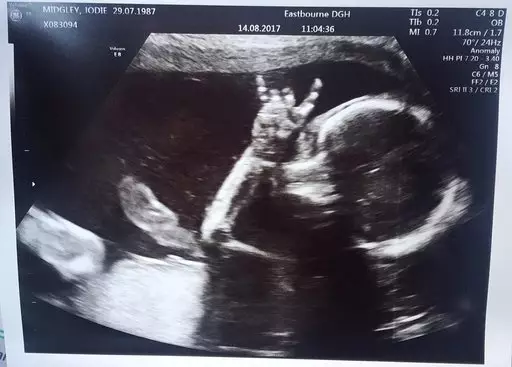 During the scan was when Isla made the hand gesture.