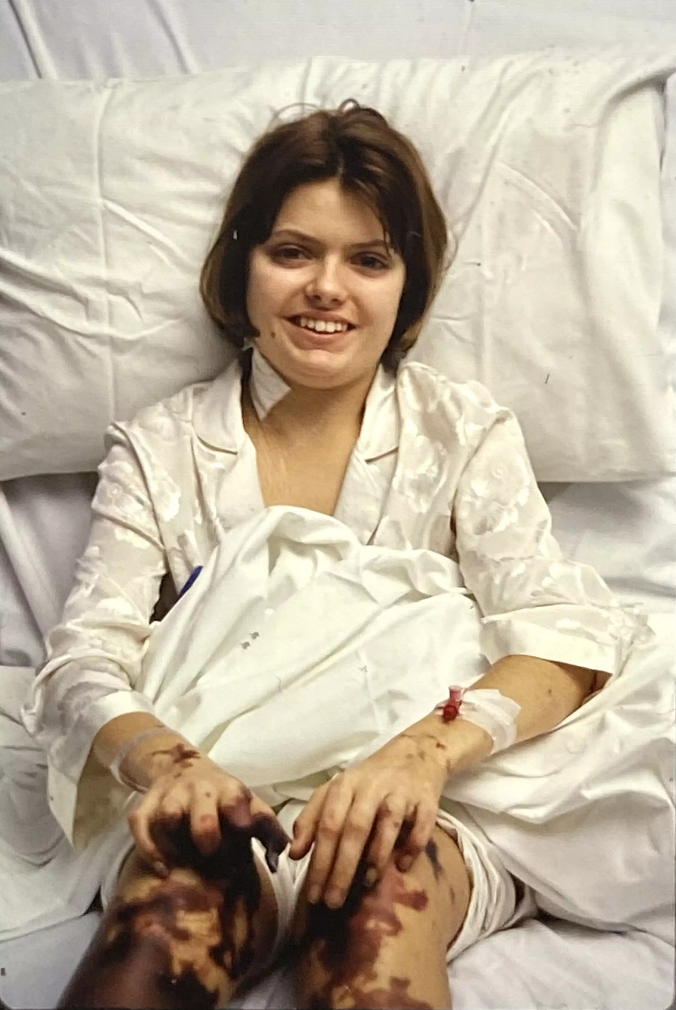 Another image shows Sophia in hospital before the amputation (