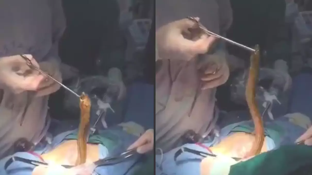 No F**king Way Did This Geezer Just Get A Live Eel Removed From His Body