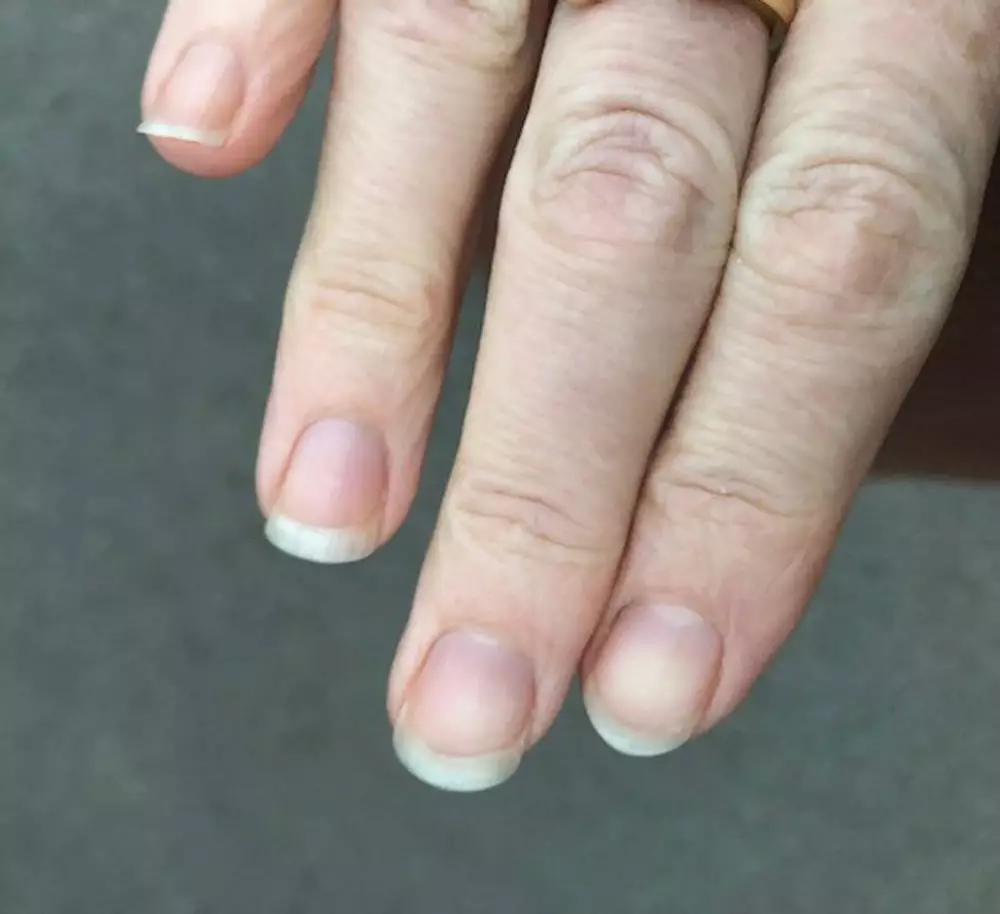 Lou's nails now after years of biting them.