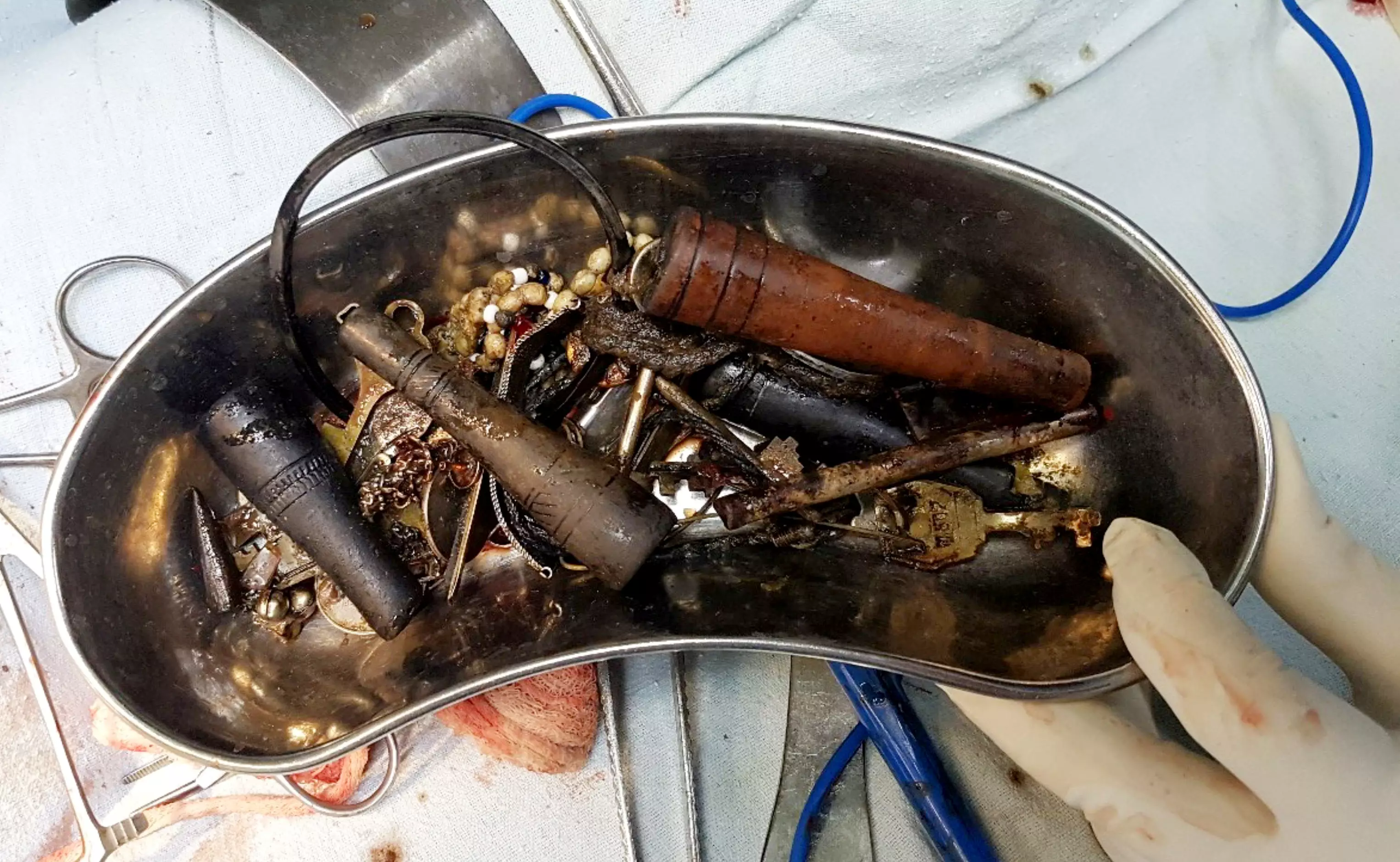 Surgeons pulled 80 items out of the 24-year-old man.