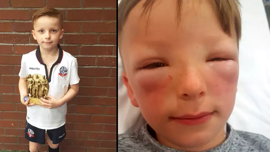 Boy's Face Trebles In Size Due To Hay Fever 