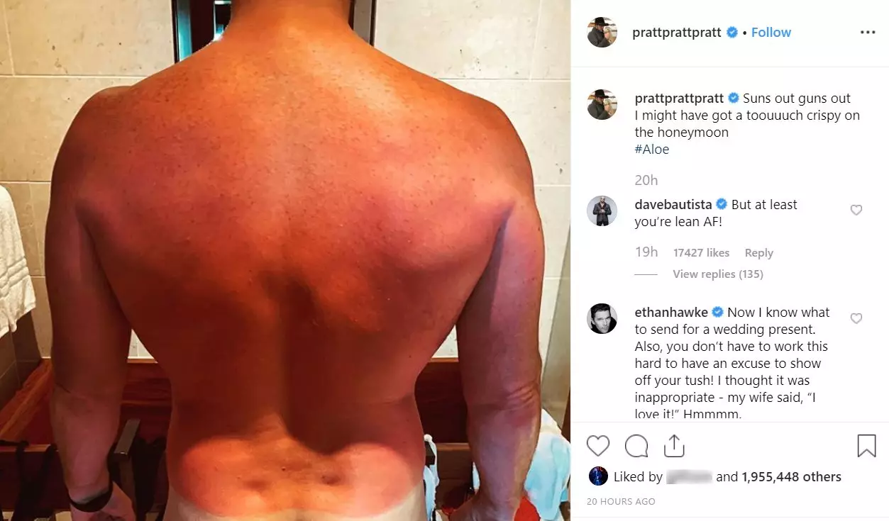 Chris Pratt posted the picture of his sunburn to Instagram.