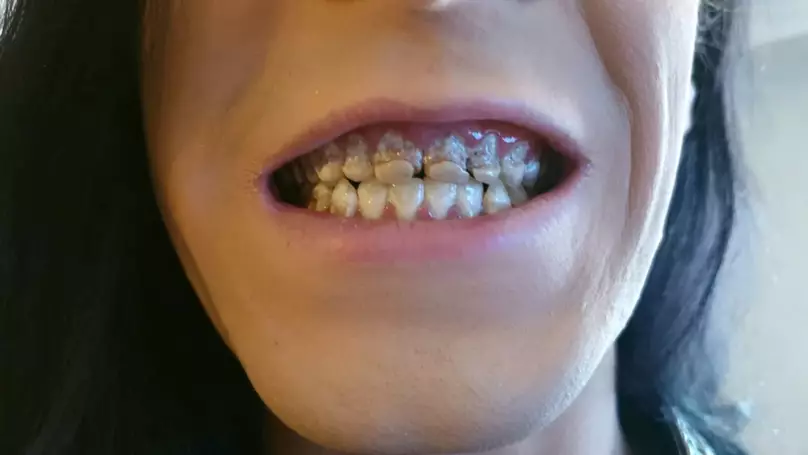 Vinnie Pyner's teeth decayed from drinking energy drinks.