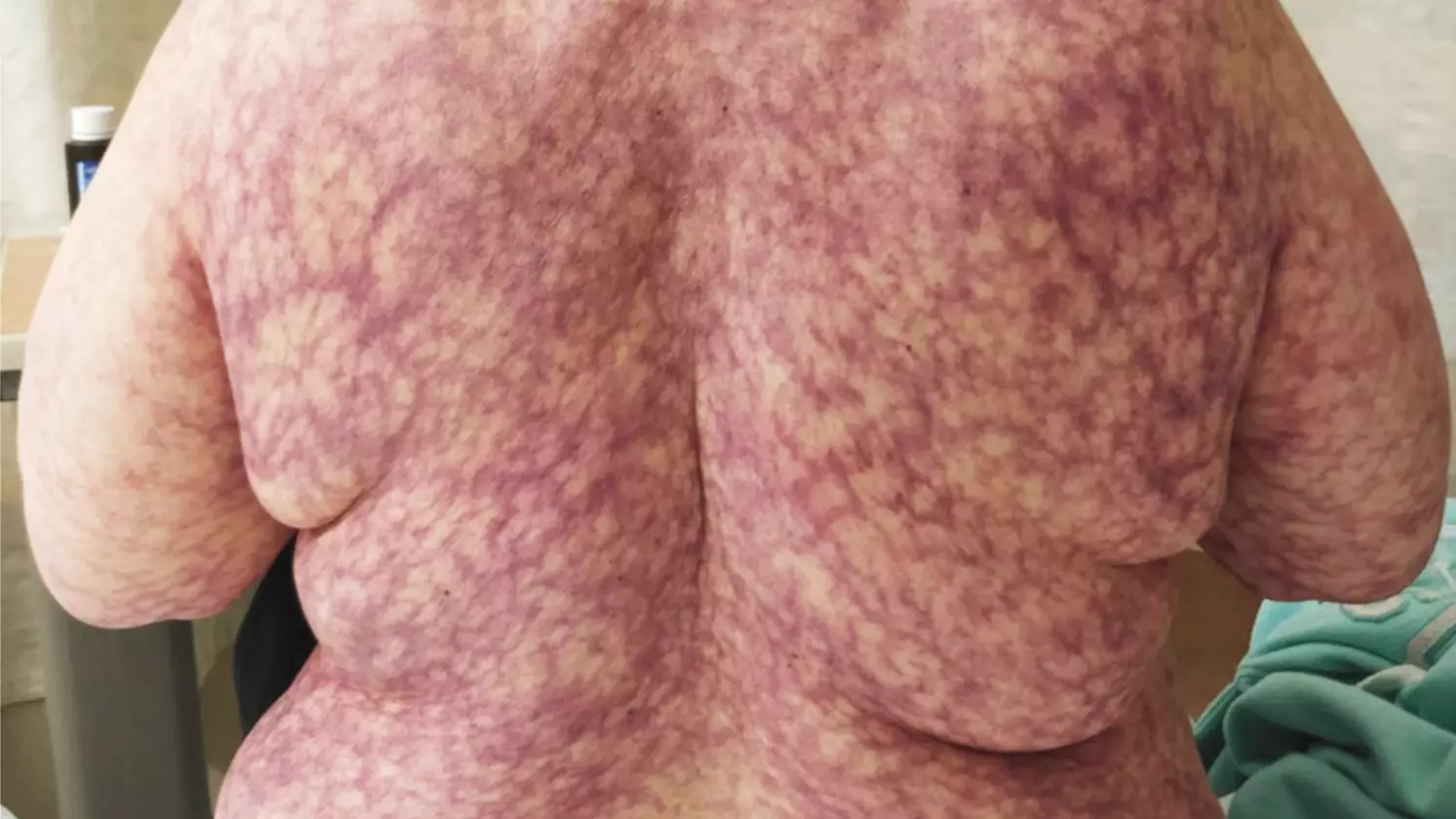 Woman Breaks Out In Web-Like Purple Rash Due To Cold Weather