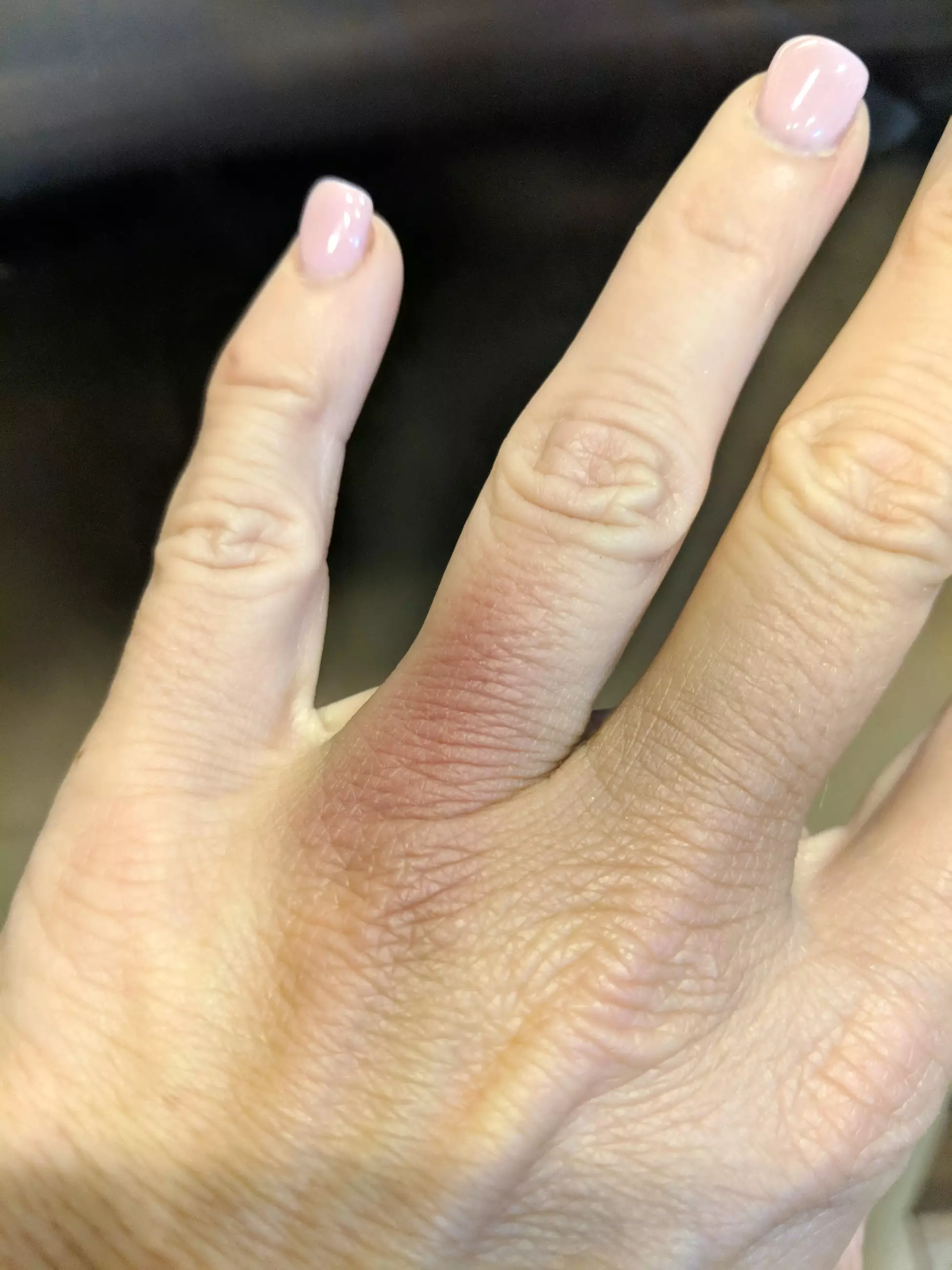 Melissa still doesn't have feeling back in her ring finger.