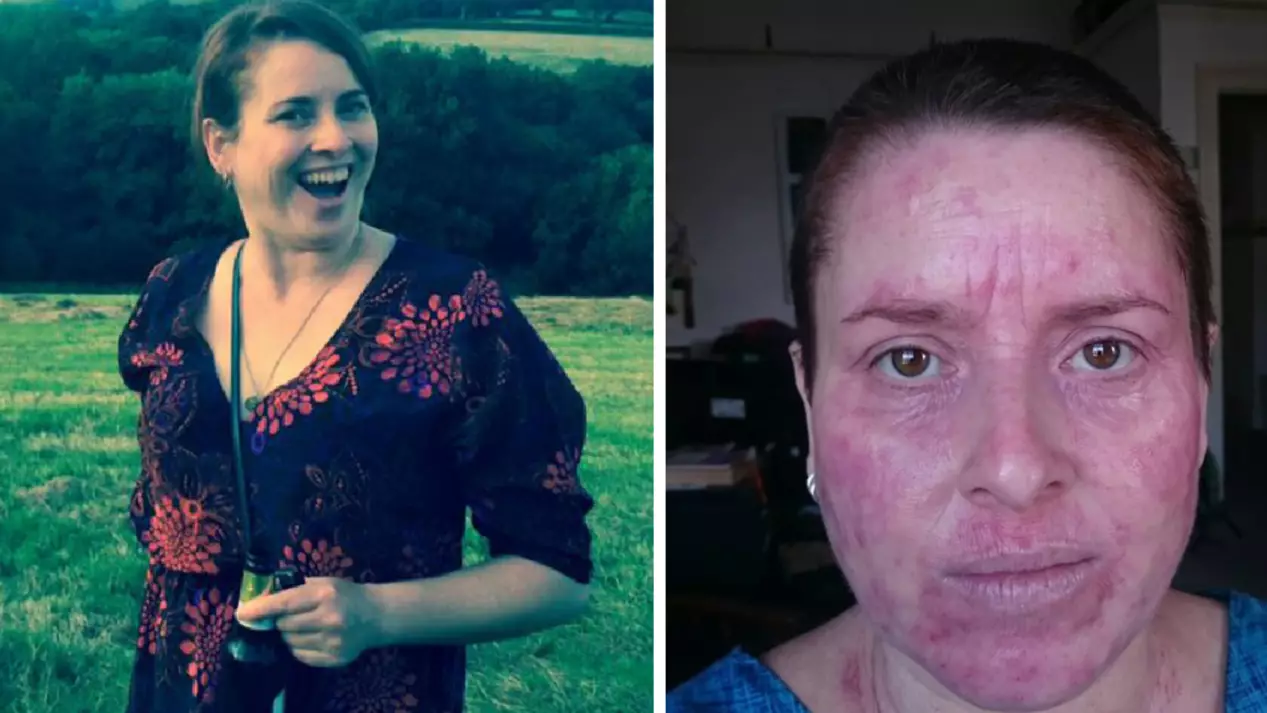 Woman's Skin 'Hot Enough To Fry Eggs On' After Beer Sparks 'Eczema Flare-Up'