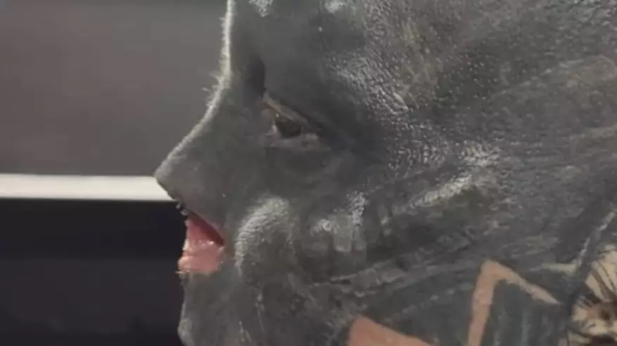 Man Who Has Transformed Himself Into 'Black Alien' Has Nose Removed