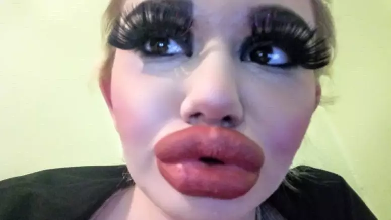 Woman Has Quadrupled The Size Of Her Lips With 17 Injections