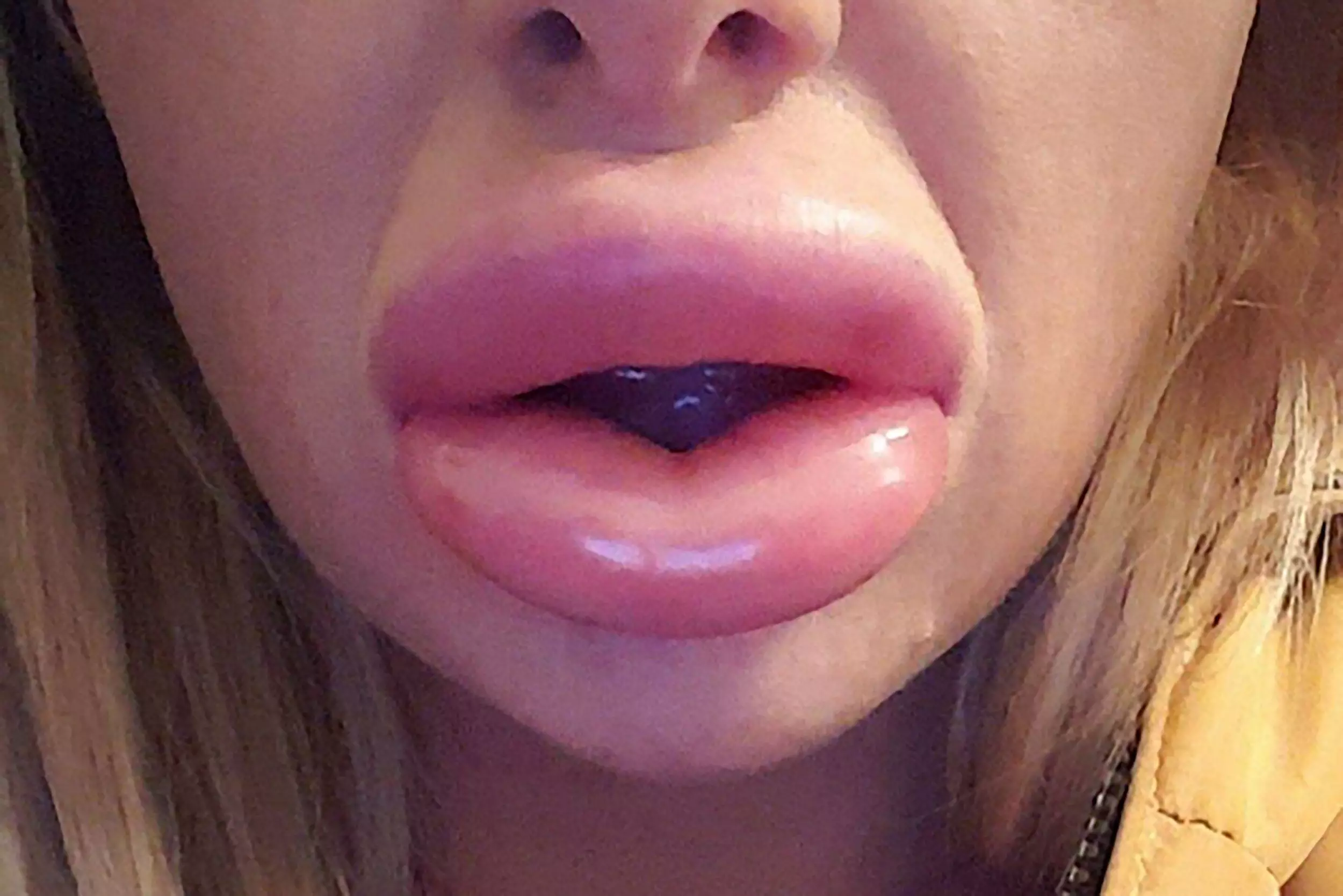 Lip Filler Botch-Job Leaves Woman With 'Two Raw Sausages' For A Mouth