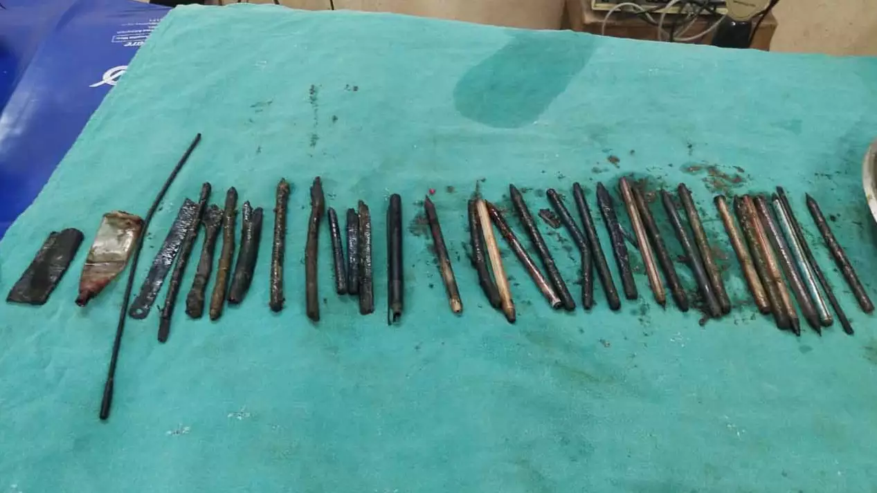 Surgeons Remove 33 Objects From Man's Stomach, Including Razor Blades 
