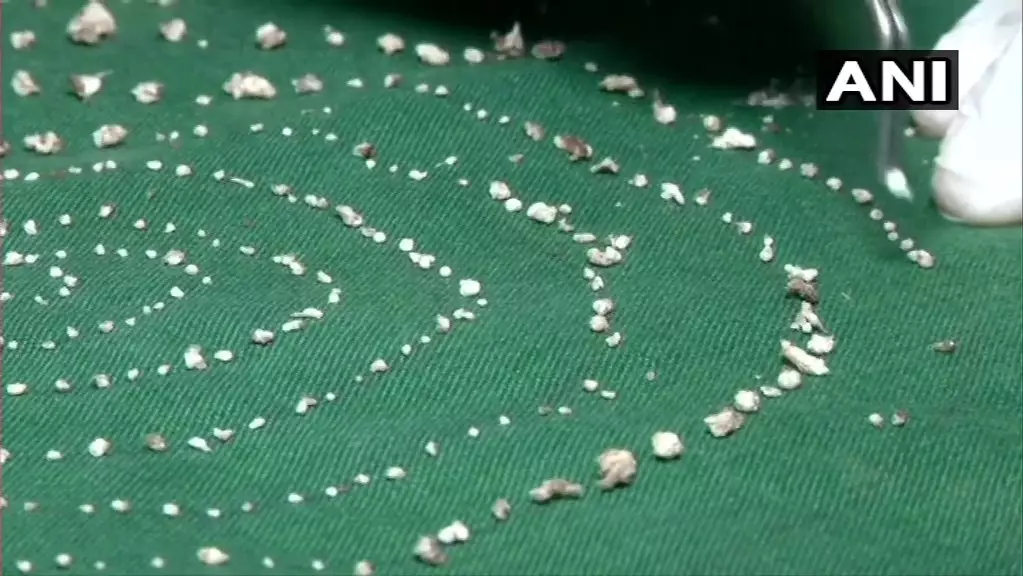 Dentists Remove 526 Teeth From The Mouth Of A Seven-Year-Old Boy