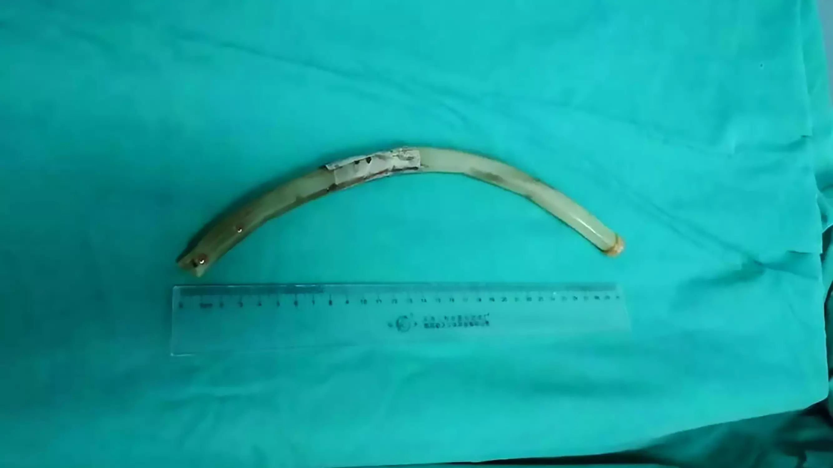 Doctors Find 12-Inch Plastic Tube Inside Woman Who Claimed She Swallowed A Straw