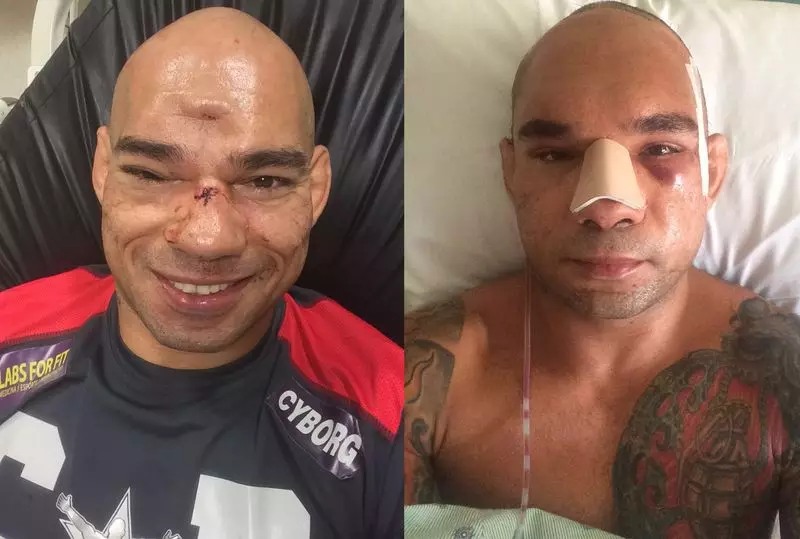 MMA Fighter Evangelista Santos​ Shows Off His Scars Following Brutal Skull Fracture