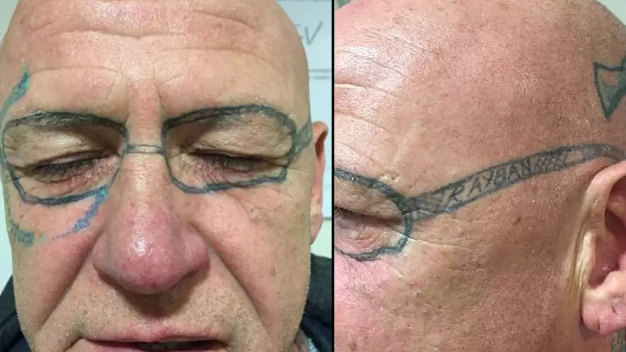 Stag Do Reveller Spends Two Years Removing Glasses Tattooed On His Face