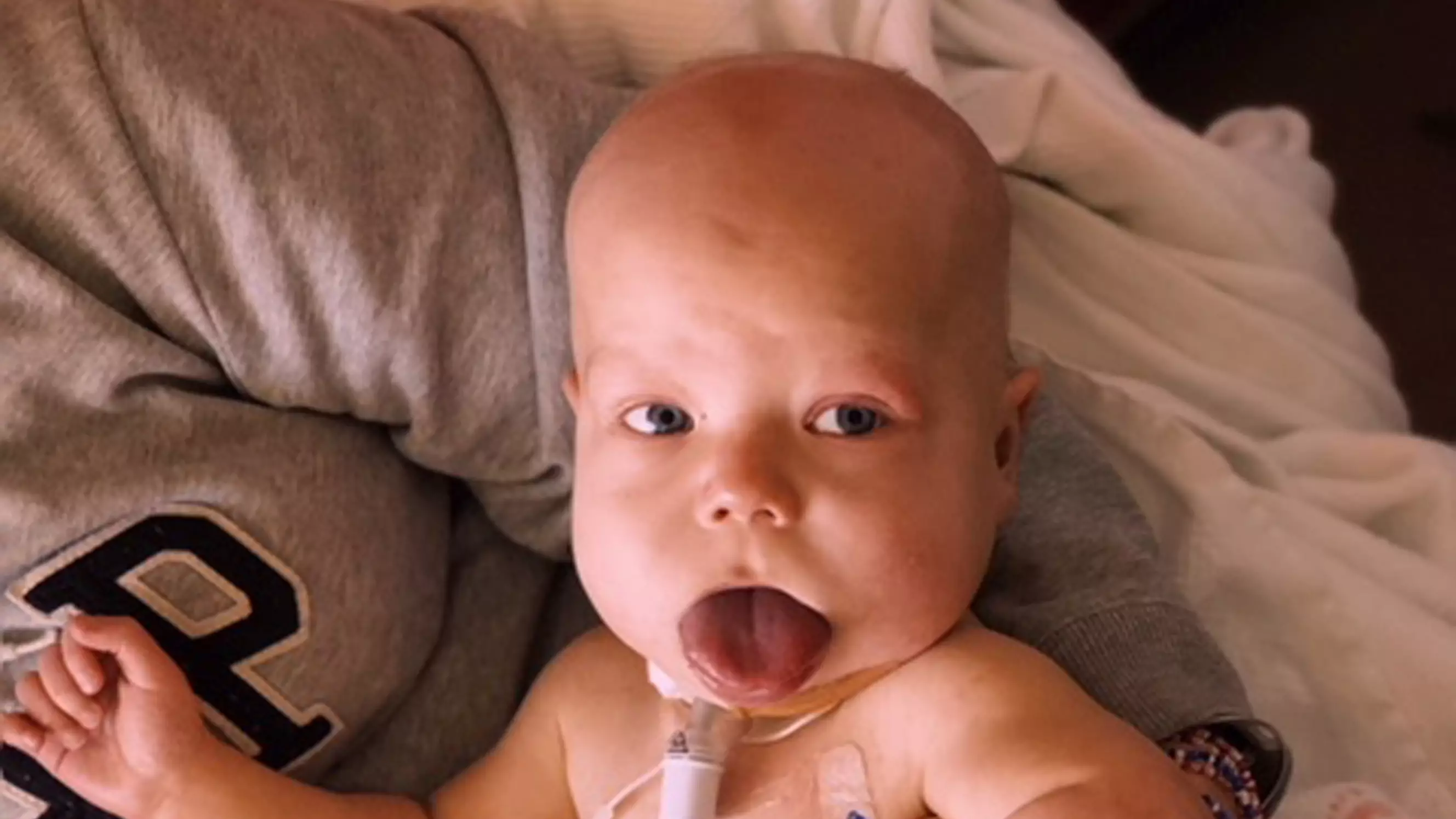 ​Toddler Born With Enlarged Tongue Has Life-Changing Surgery