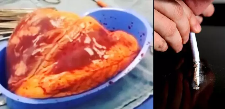 Grim Video Shows The Damage Cocaine Abuse Does To The Heart