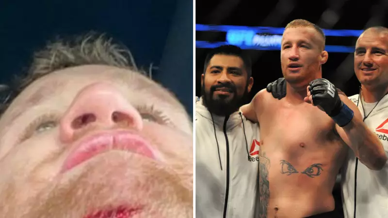 Justin Gaethje Shows Off Gruesome Injury Sustained In Training