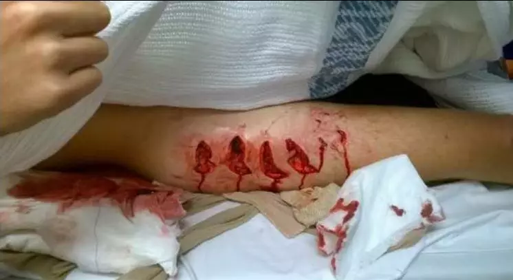 Great White Shark Leaves Horrific Wounds In Teenager Surfer's Leg