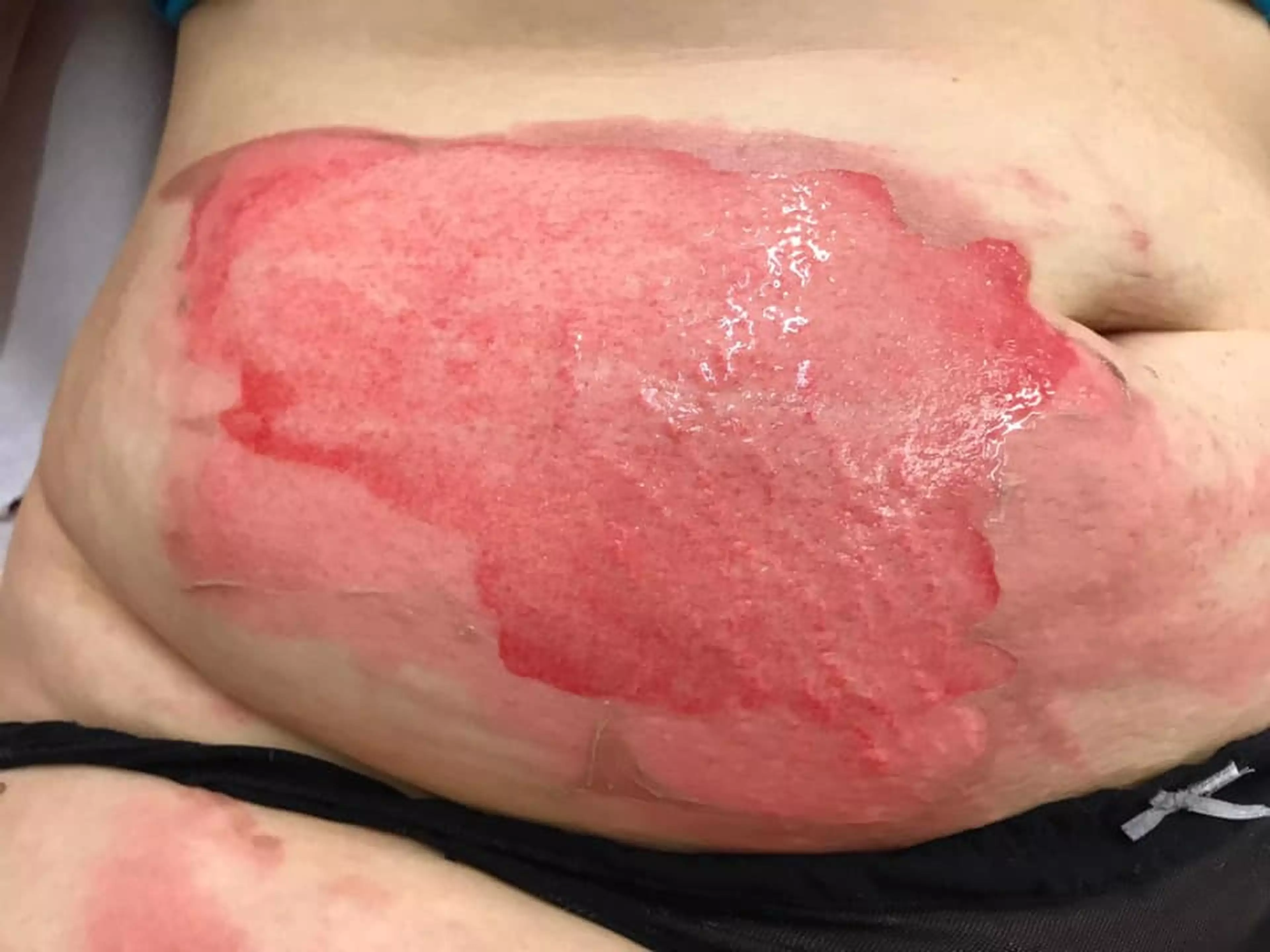 Sophie received severe burns on her stomach