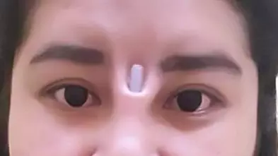 Thai Woman Shows Off Just How Bad A Botched Nose Job Can Look 