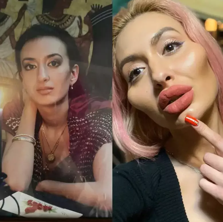 Before and after she got fillers.