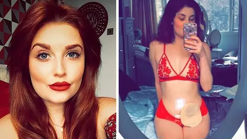 Teaching Assistant Poses With Stoma Bag To Inspire Body Confidence
