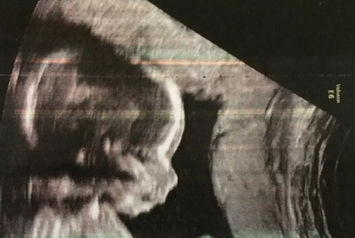 The Baby In This Ultrasound Probably Has A Bigger Wang Than You