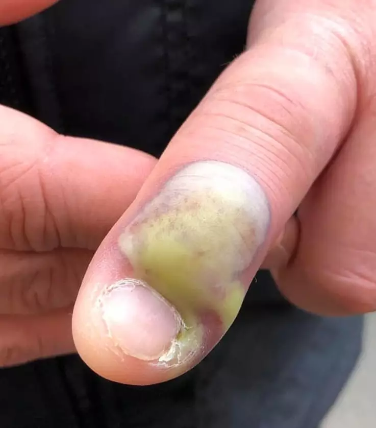 A woman has warned people not to bite their fingernails.