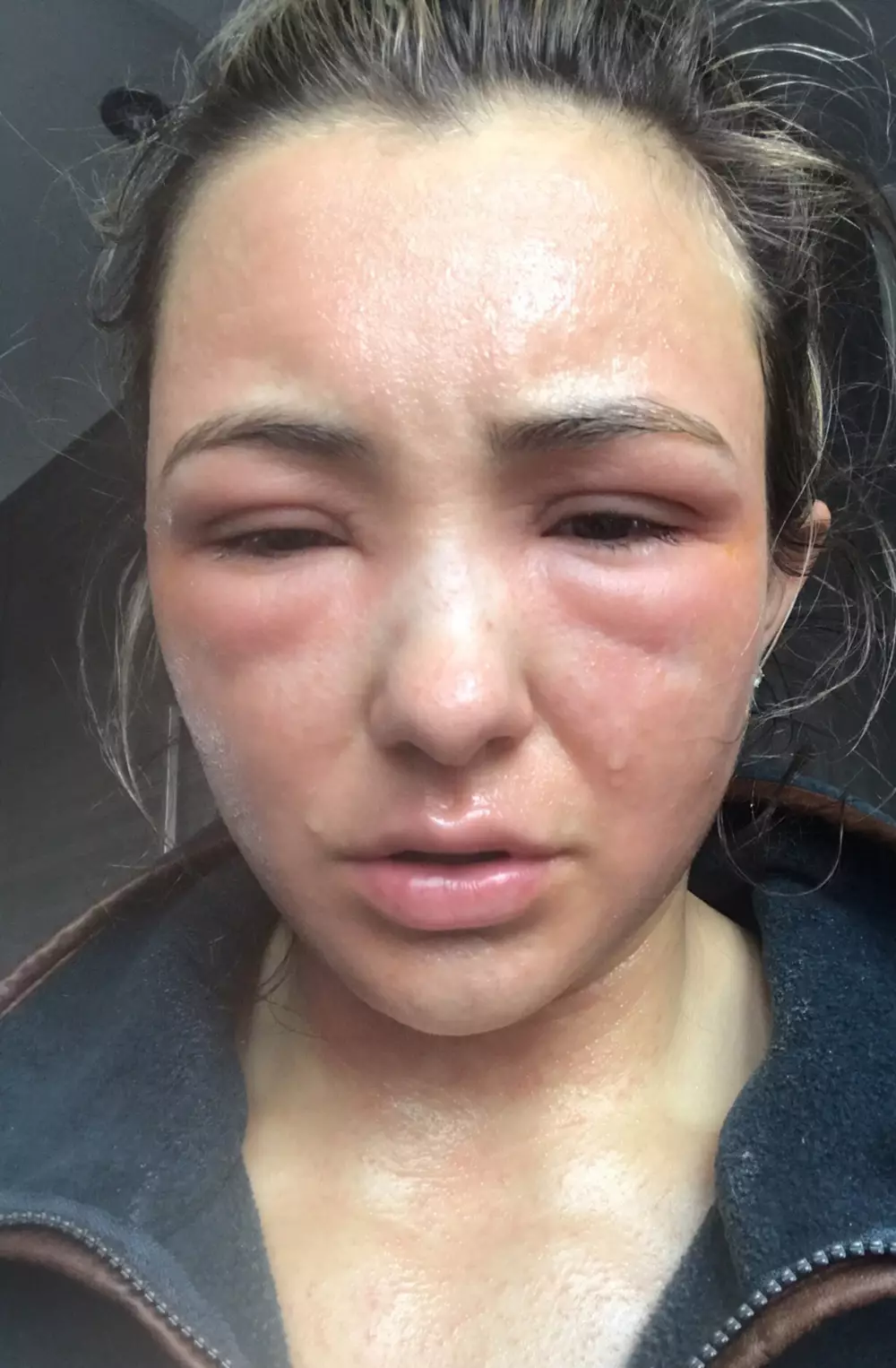 Eden's skin was so sore and swollen that she was mistaken for a victim of domestic abuse (
