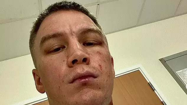 Boxer Reveals Horrific Burns Suffered In Acid Attack In UK Hotel Room