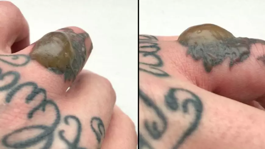 Man Develops Huge Disgusting Blister On Finger After Laser Tattoo Removal Session