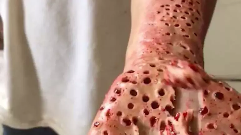 Woman's Creepy Facebook Posts Are Freaking Out People With Trypophobia