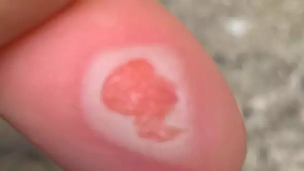 Woman Shocked To Discover Blister On Her Finger Looks Like The Queen